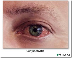 Allergic Conjunctivitis