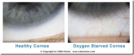 Insight_blog_Oxygenstarvedcornea