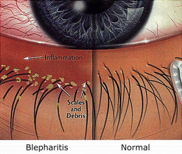 Blepharitis-compare (1)